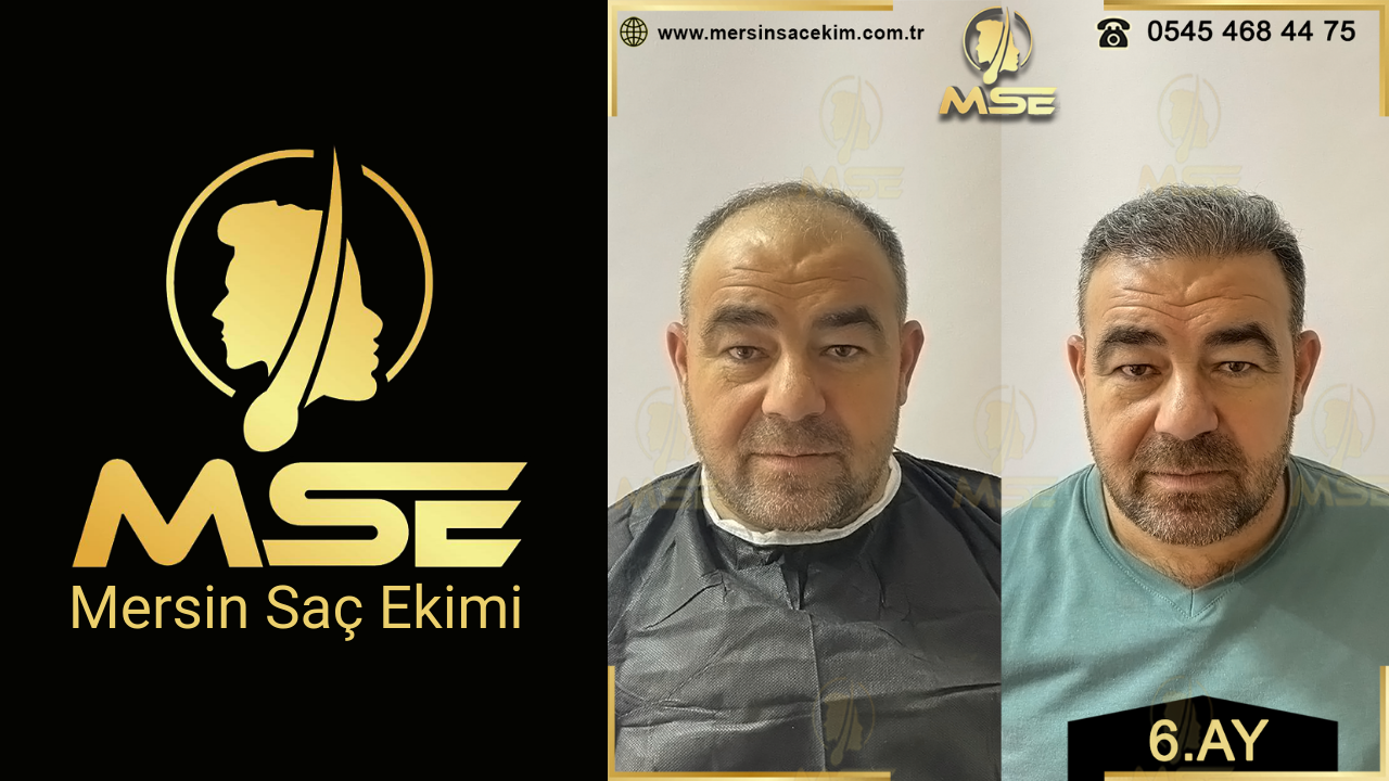 Mersin Saç Ekimi